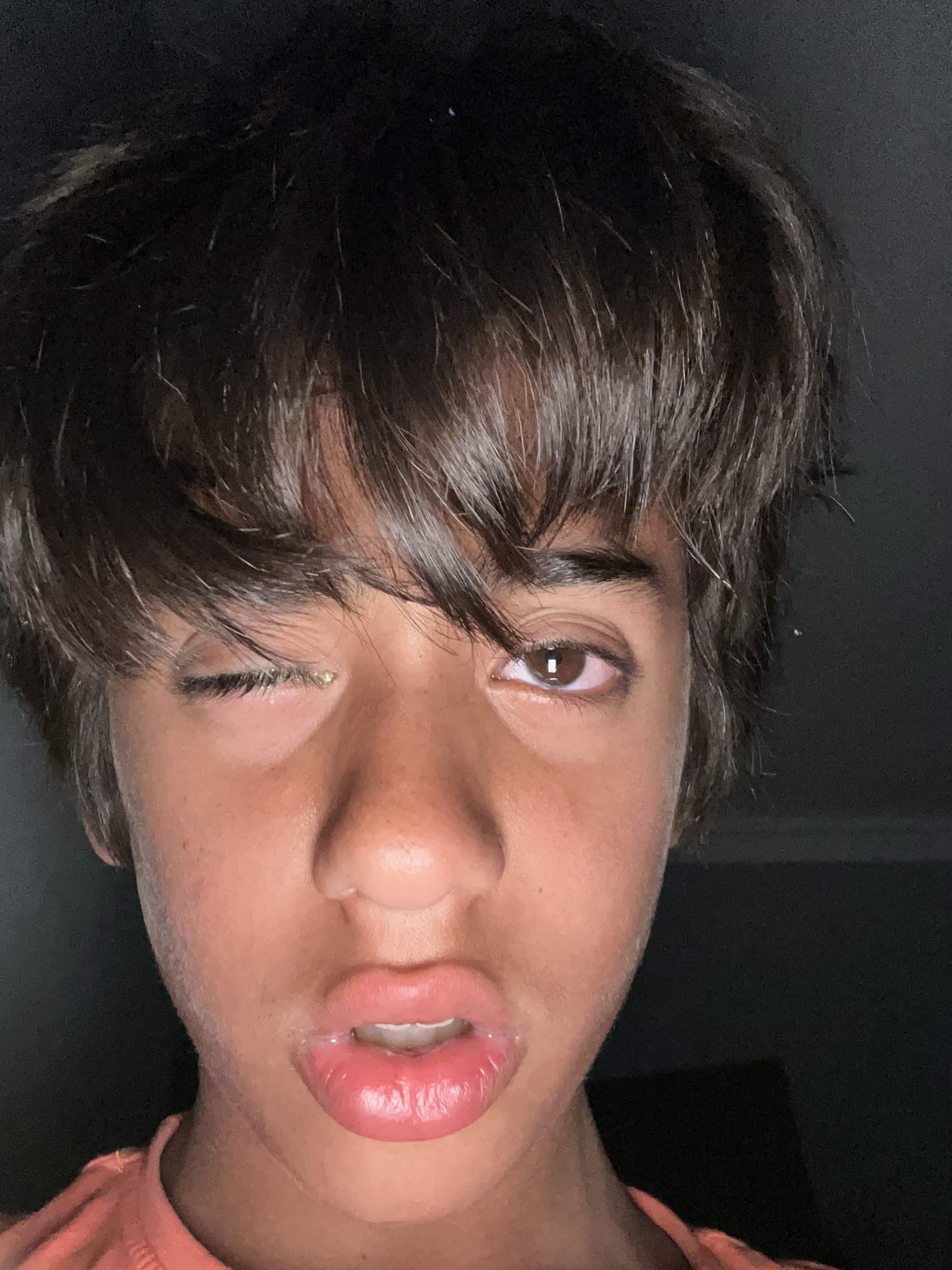 Pinkeye