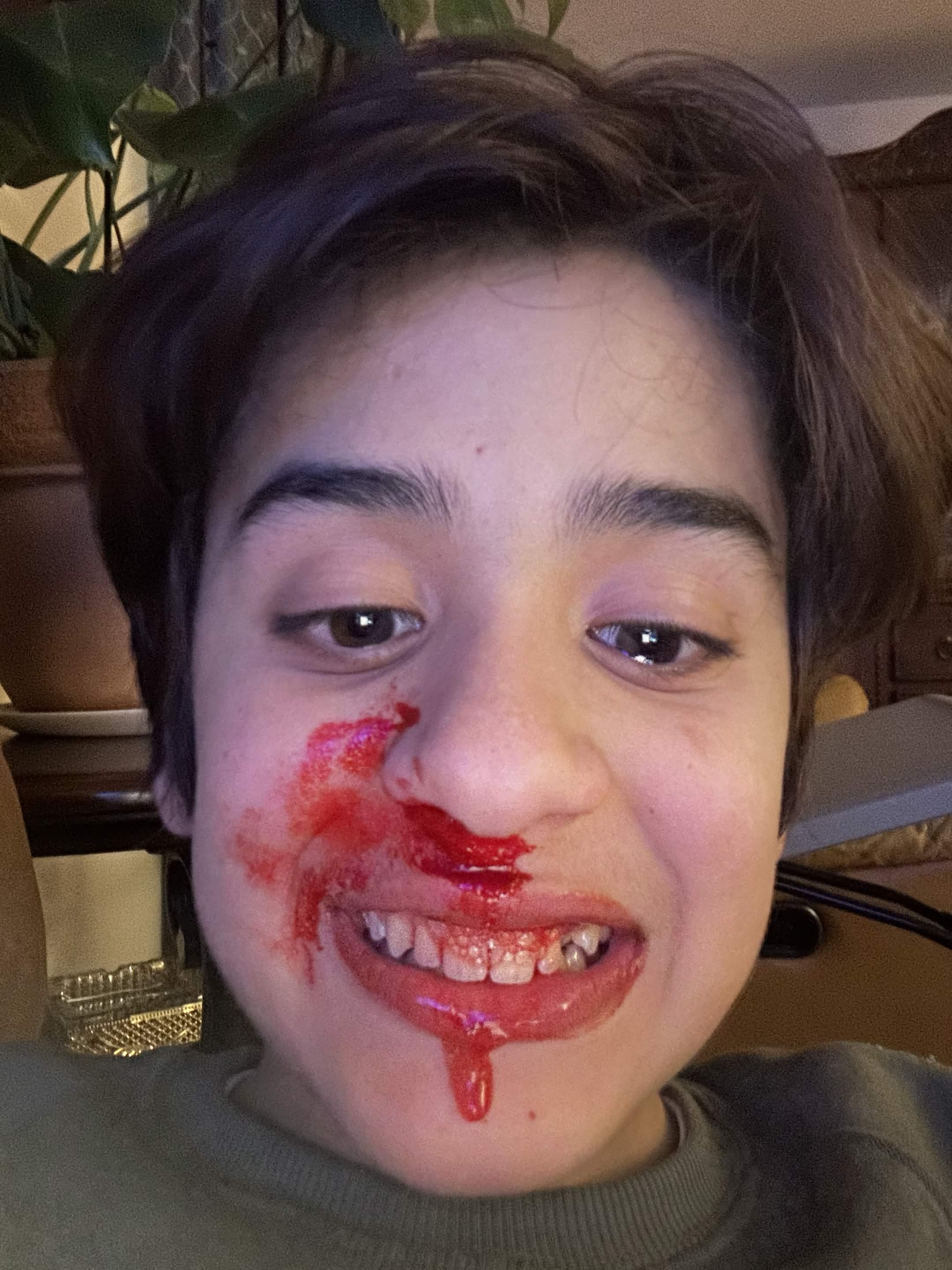 Nose bleed 2.0